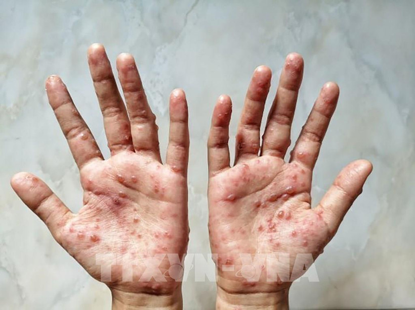 Các ban đỏ nổi trên tay một bệnh nhân mắc bệnh đậu mùa khỉ. Ảnh: Shutterstock/TTXVN