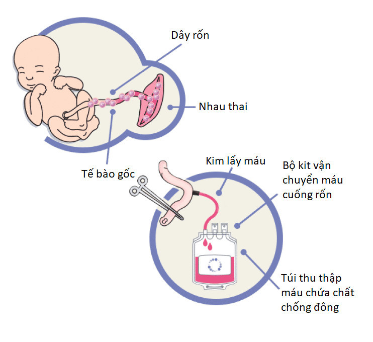 Máu dây rốn được thu thập từ dây rốn đã cắt khỏi em bé và lưu trữ trong túi chuyên dụng. Nguồn: buudienhospital.vn 