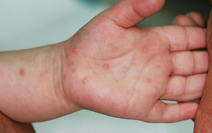 Bác sĩ Khoa Nhi - Bệnh viên Đa khoa vùng Tây Nguyên thăm khám cho bệnh nhi bị tay chân miệng. Ảnh: vov.vn