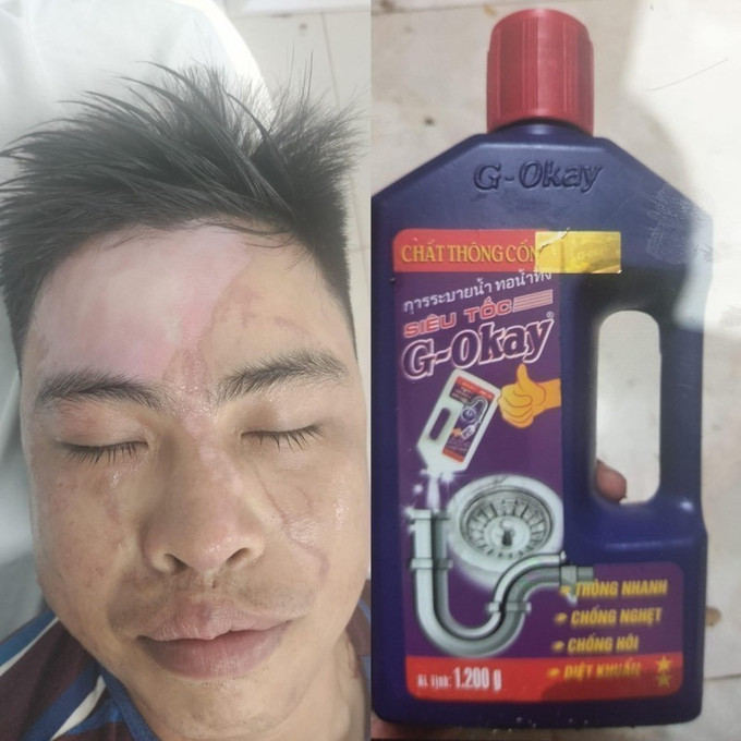 Nạn nhân T.V.T tại Gia Lai bị bỏng nặng do chai nước thông cống nhãn hiệu G-Okay phát nổ khi sử dụng. Ảnh: TTXVN phát Cẩn trọng khi sử dụng các loại dung dịch thông tắc ảnh 1