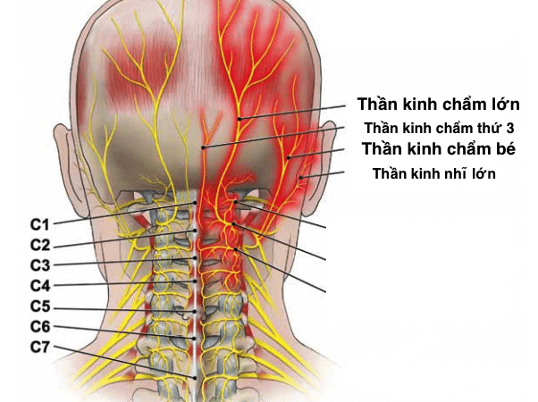 Đau dây thần kinh chẩm là một nguyên nhân phổ biến gây đau đầu. Ảnh: vinmec.com Hướng đi mới trong điều trị chứng đau dây thần kinh ảnh 1