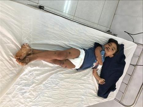 Cháu Vươn dần hồi phục sức khỏe tại Bệnh viện Nhi tỉnh Gia Lai. Ảnh: Hồng Điệp - TTXVN Hai trẻ bị ong đốt tại Gia Lai: Bệnh nhi bị đốt hơn 50 nốt đã qua cơn nguy kịch ảnh 1