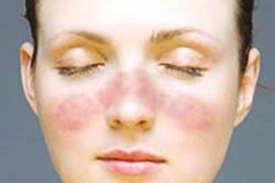 Phát hiện gene gây bệnh lupus ban đỏ