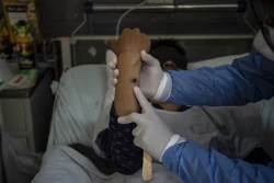Bệnh nhân đậu mùa khỉ có thể truyền virus trước khi xuất hiện triệu chứng bệnh