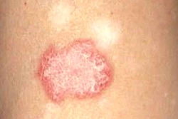 Tìm ra phương pháp mới điều trị lupus ban đỏ