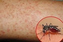 Các hạn chế để phòng ngừa COVID-19 có thể liên quan đến việc giảm mạnh số ca sốt xuất huyết 