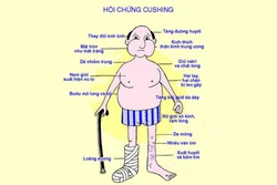 Điều trị thành công ca bệnh mắc Hội chứng Cushing với nhiều biến chứng nặng