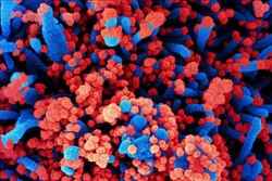 Virus SARS-CoV-2 có khả năng tấn công não bộ bệnh nhân
