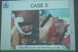Thành phố Hồ Chí Minh: Cảnh báo tai nạn thương tích trẻ em do chó cắn