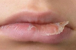 Cách giúp môi không bị nẻ khi trời khô hanh