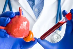 Nghiên cứu của Mỹ nhấn mạnh tầm quan trọng của tầm soát ung thư tuyến tiền liệt