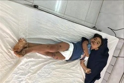 Cháu Vươn dần hồi phục sức khỏe tại Bệnh viện Nhi tỉnh Gia Lai. Ảnh: Hồng Điệp - TTXVN