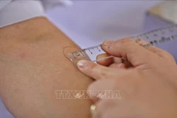 Kỹ thuật viên thực hiện tiêm TST để chẩn đoán nhiễm lao cho người tiếp xúc với ca bệnh lao. Ảnh: Minh Quyết – TTXVN
