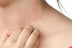 Nghiên cứu về phương pháp chữa trị bệnh phát ban đỏ