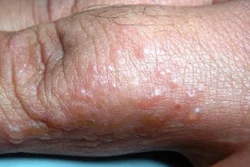 Quảng Ngãi: Xử lý bệnh ghẻ đang lây lan trong thôn có đông đồng bào dân tộc Cor