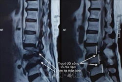 Cần Thơ: Bước tiến mới trong điều trị bệnh trượt đốt sống thắt lưng