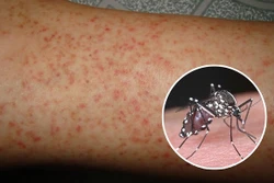 Đắk Lắk ghi nhận trường hợp thứ 3 tử vong do sốt xuất huyết