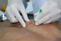 Thủy châm: Phương pháp điều trị kết hợp y học hiện đại và y học cổ truyền