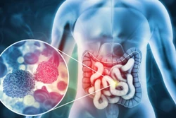 Australia nghiên cứu tìm ra cách mới chẩn trị chính xác ung thư ruột