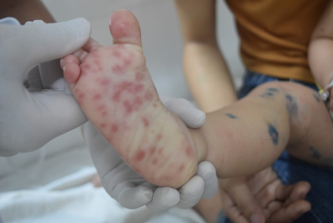 Các nốt phát ban của bệnh nhi bị tay chân miệng. Các nốt phát ban của bệnh nhi bị tay chân miệng.