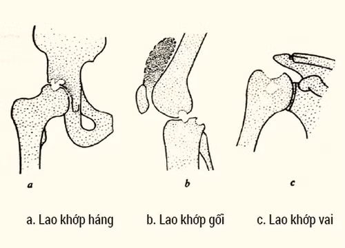Bệnh lao xương khớp: Xin đừng chủ quan