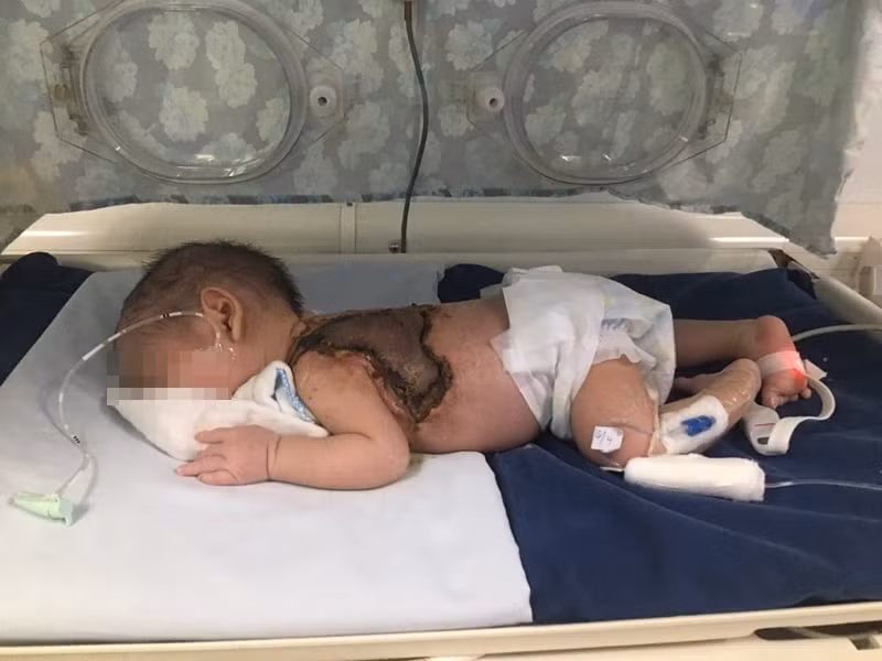Dùng kim khâu chích mụn, bé sơ sinh nhiễm trùng huyết nguy hiểm 