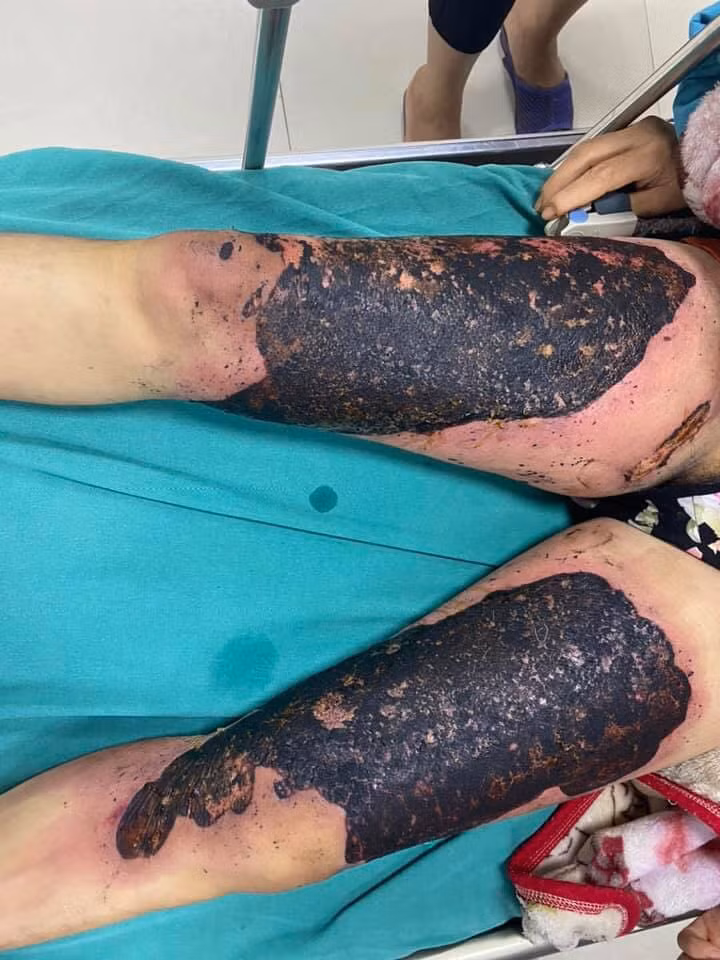 Nhiễm trùng nặng do tự đắp thuốc lá chữa bỏng