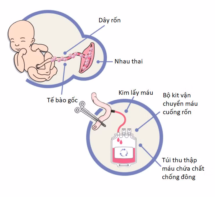 Máu dây rốn được thu thập từ dây rốn đã cắt khỏi em bé và lưu trữ trong túi chuyên dụng. Nguồn: buudienhospital.vn 